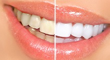 Closeup of woman’s smile that’s half whitened