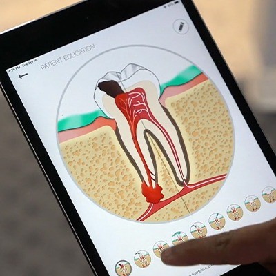 Animation of the inside of a damaged tooth