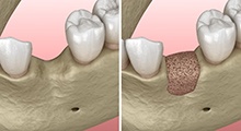 Digital illustration of bone grafting for dental implants in McKinney