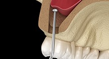 Digital illustration of a sinus lift for dental implants in McKinney