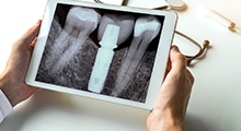 dentist looking at X-ray after ridge expansion for dental implants in McKinney 