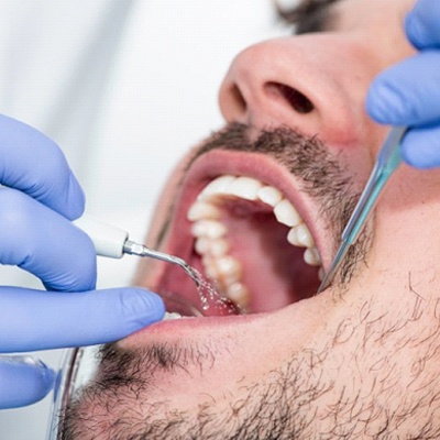 bearded man getting teeth cleaned