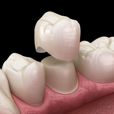 diagram of dental crown being placed over bottom tooth