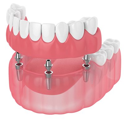 Digital illustration of implant denture in McKinney