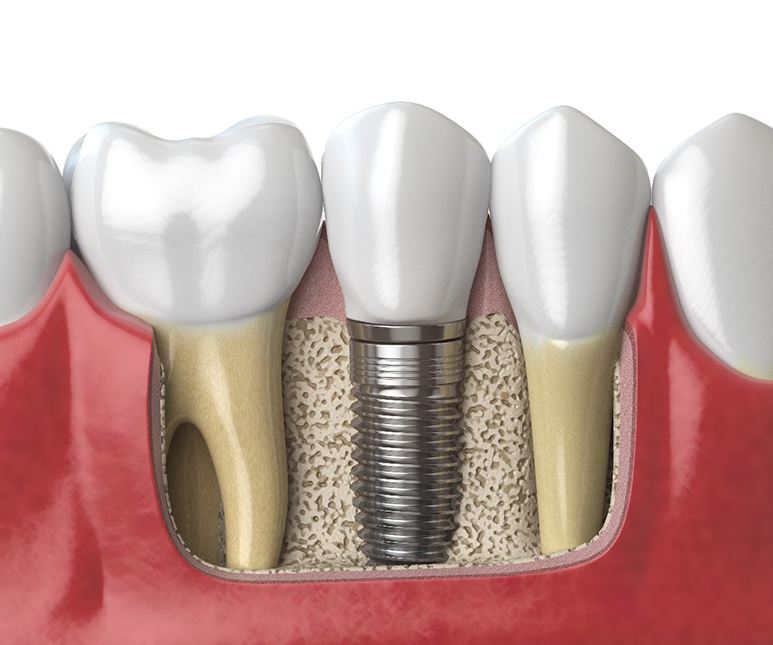 Diagram of dental implants in McKinney after placement