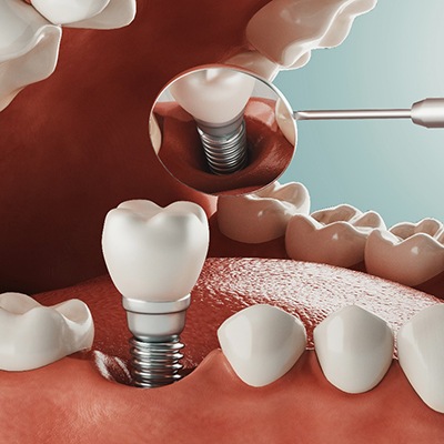 Diagram showing how dental implants in McKinney work