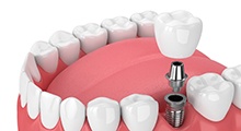 Diagram of a single tooth dental implant in McKinney