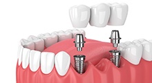 Diagram showing implant bridge replacing multiple missing teeth in McKinney