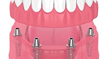 Diagram of an implant denture in McKinney