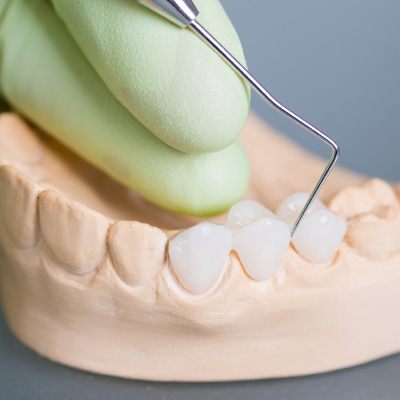 Model smile with fixed bridge restoration