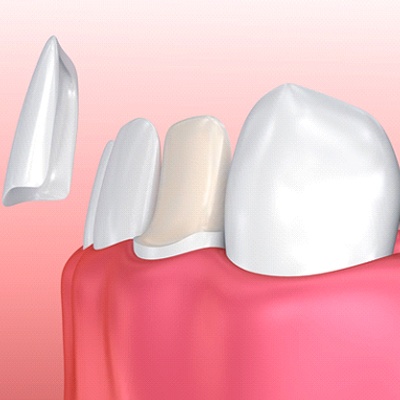 porcelain veneers diagram 