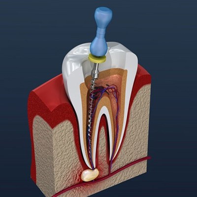 diagram of root canal therapy