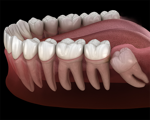 Illustration of an impacted wisdom tooth