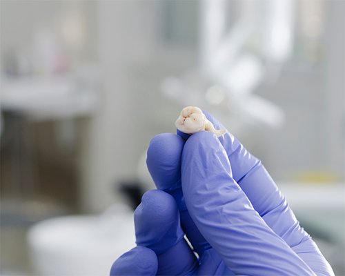 Gloved hand holding an extracted wisdom tooth