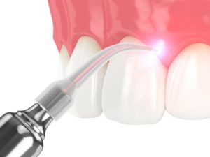 Illustration of soft tissue laser used by dentist in McKinney