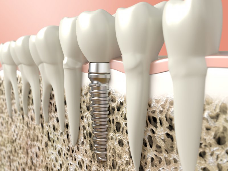 Diagram showing how dental implants in Frisco integrate with bone