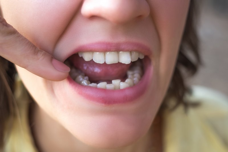 A woman with crooked teeth in Frisco