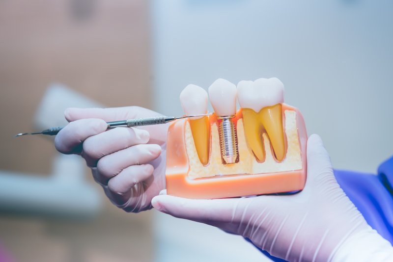 a dentist in Frisco showing an example of dental implants